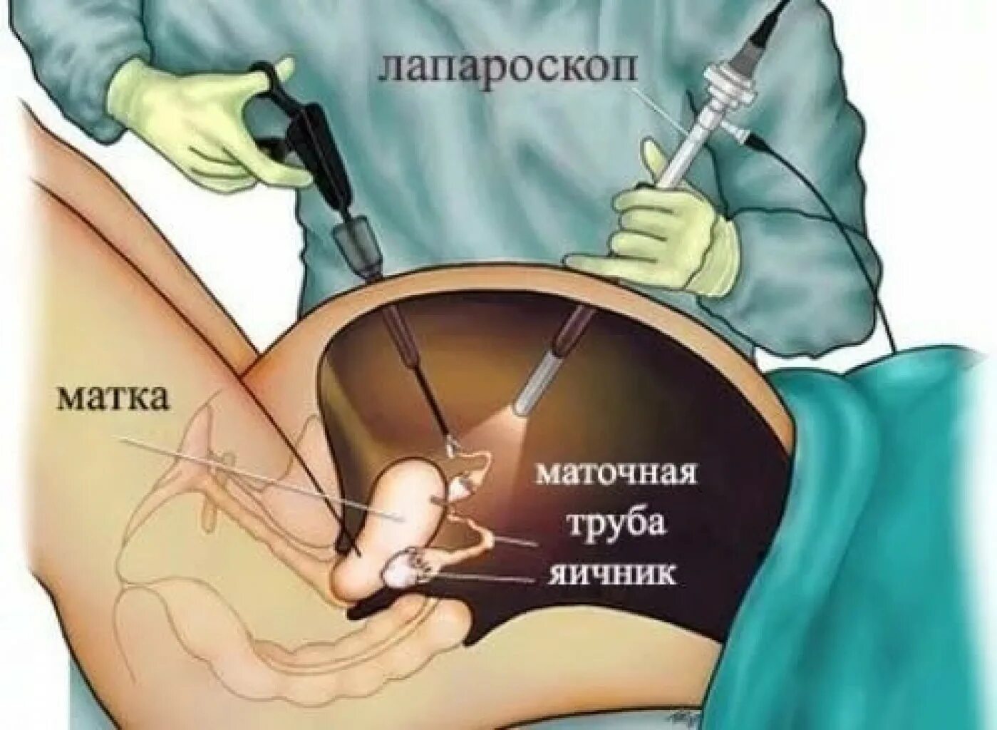 Накопить на: Операция лапароскопия, цель - собрать 90,000 руб. Deels.ru