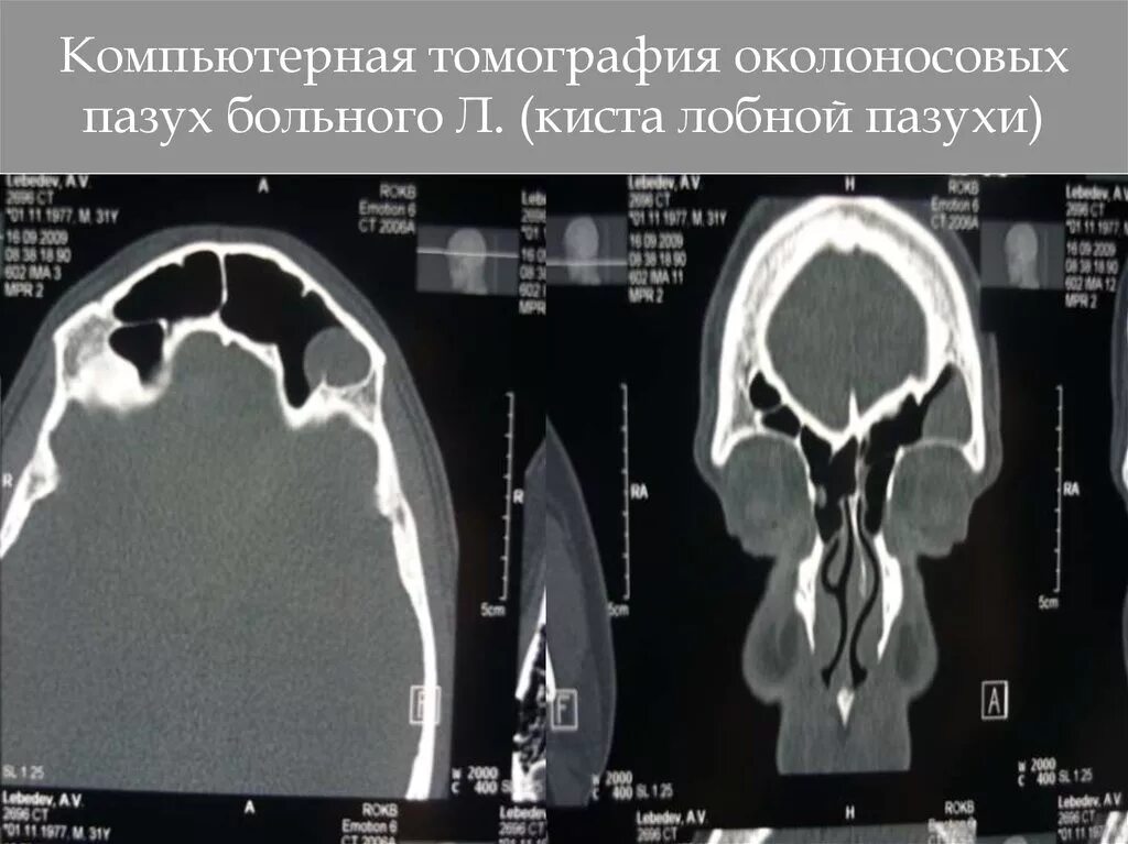 Киста в лобной доле. Киста околоносовой пазухи кт. Киста лобной пазухи мрт.