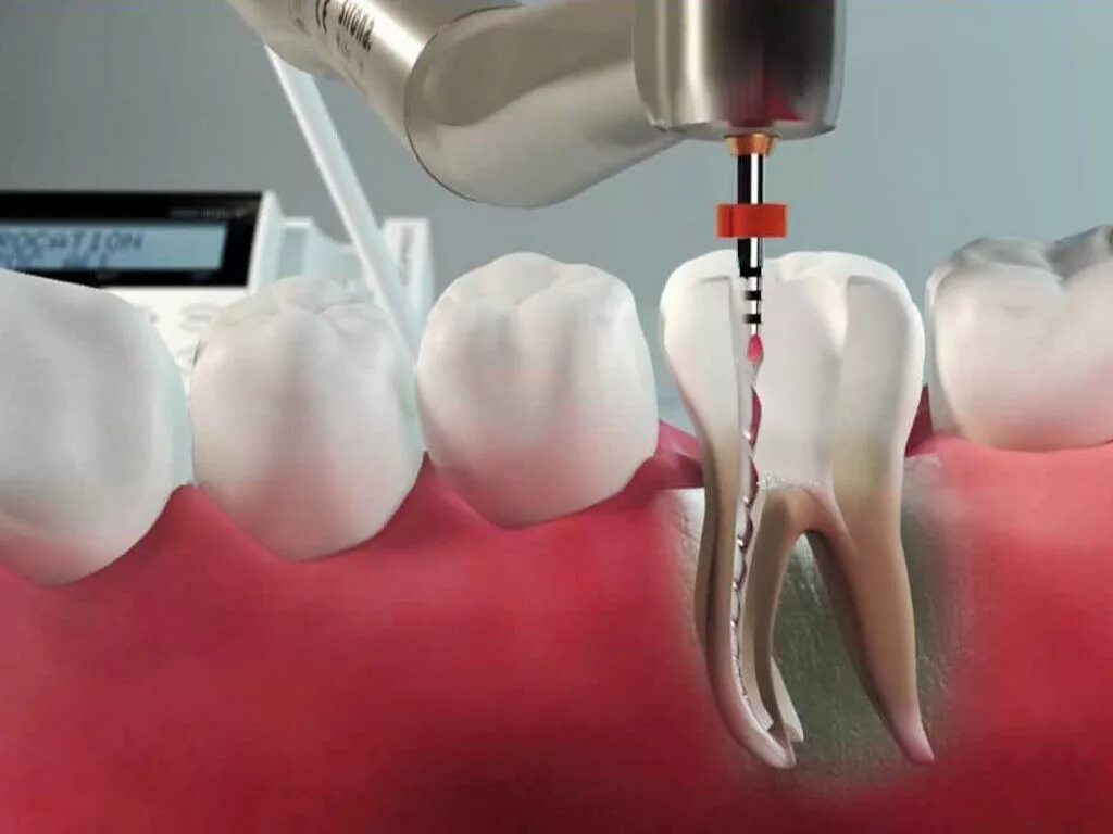Отзывы после лечения зубов. Эндодонтическое перелечивание зубов. Пульпит корневого канала. 4 Канальный пульпит зуба.
