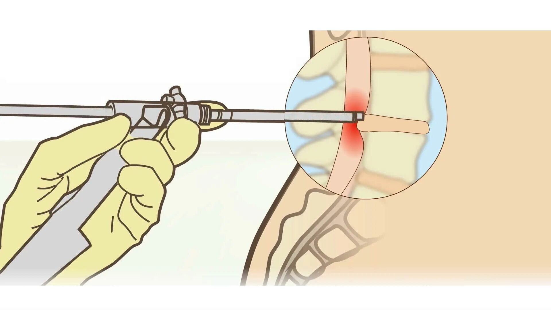 Блокада межпозвонкового диска и грыжи. Блокада грыжа межпозвоночного диска. Дискэктомия поясничного отдела позвоночника. Эндоскопическая дискэктомия поясничного отдела позвоночника. Позвоночник операция лазером