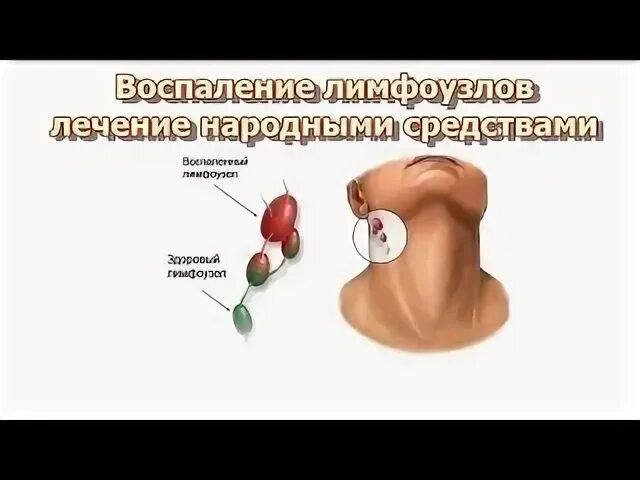 Антибиотики при воспалении лимфоузлов подмышками список. Воспаление лимфатического узла препарат. таблетки при воспалении лимфоузлов на шее. противовоспалительные препараты при воспалении лимфоузлов на шее. антибиотики при воспалении лимфоузлов на шее.