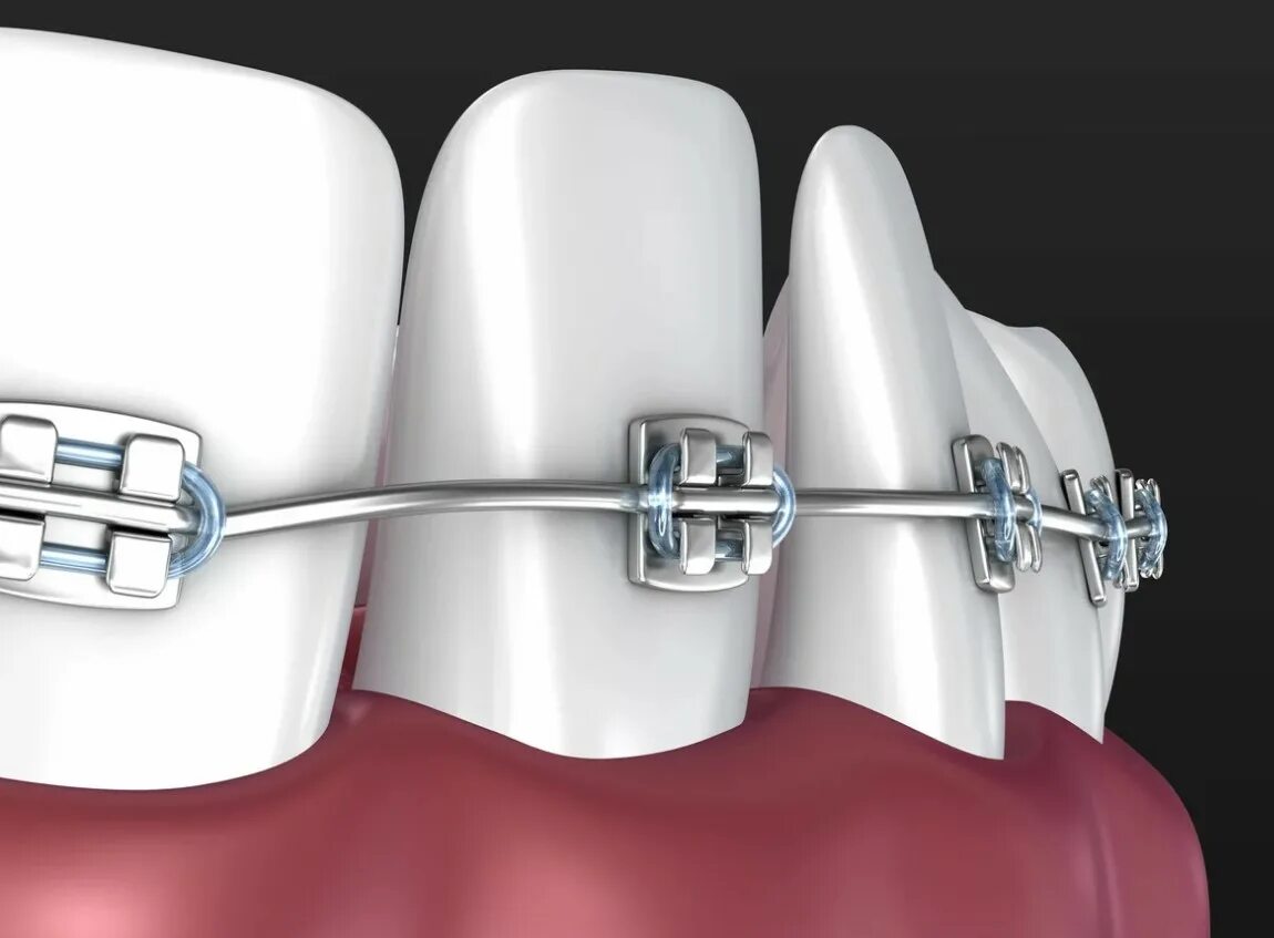Брекеты pure (ortho technology, сша). Брекеты дэймон q. Брекет система лигатурная самолигирующие. Проект брекет система. Фиксация (лигатурной) металлической брекет- системы.