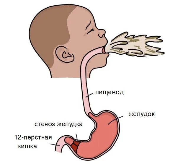 Рубцовый стеноз привратника. Стеноз желудка что это. Сужение привратника желудка рентген. Стеноз привратника причины. Стеноз желудка что это.