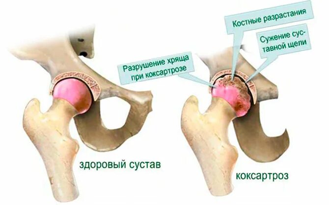 Какая боль при коксартрозе