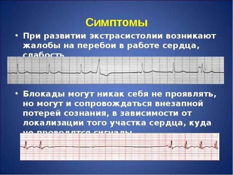 Замирание сердца пропуски ударов. Замирание сердца пропуски ударов