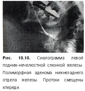 Опухоли слюнных желез у детей по утвержденным