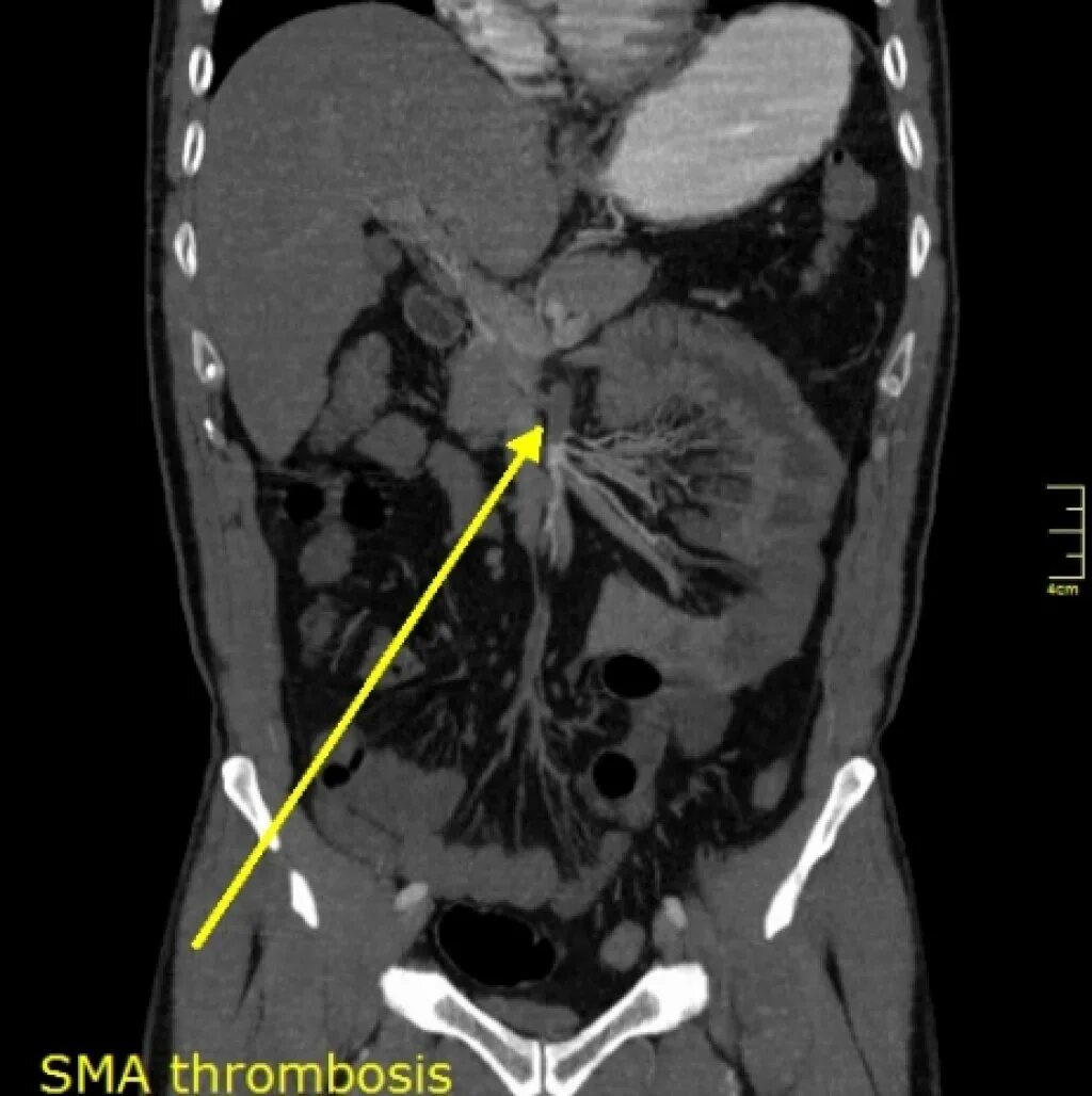 Мезентериальная ишемия. Тромбоз сосудов брыжейки на кт. Тромбоз мезентериальных сосудов на кт. Тромбоз мезентериальных вен кт. Тромбоз мезентериальных сосудов кишечника кт.