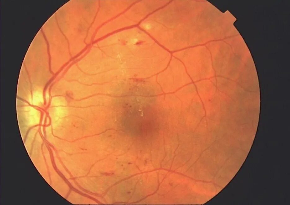 Гипертоническая ангиопатия и ретинопатия. Геморрагическая ретинопатия. Гипертоническая ретинопатия глазное дно. Вальсальва ретинопатия. Сетчатки по гипертоническому типу