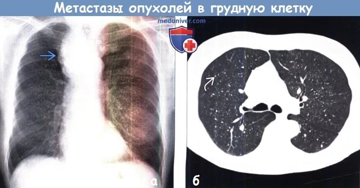 Метастазы при раке щитовидной железы