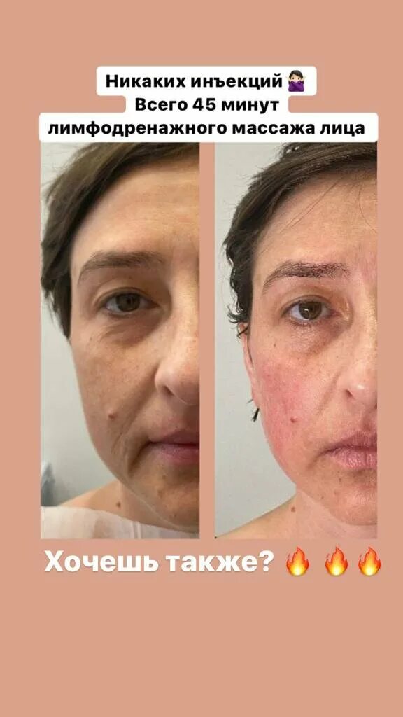 лазерная эпиляция железнодорожный. лазерная балашиха. дмитриева. студия лазера бора новороссийск. студия красоты балашиха флерова 3.