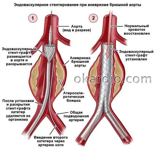 Аневризма брюшной аорты симптомы лечение. Аневризма брюшной аорты симптомы лечение