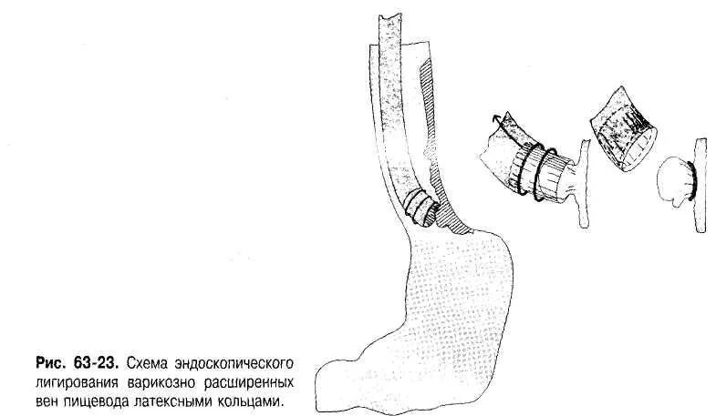 Лечение варикозных вен пищевода. ВРВП -варикозное расширение вен пищевода. Эндоскопическое лигирование варикозно расширенных вен пищевода. Кольца для лигирования вен пищевода. Лигирование ВРВ пищевода.