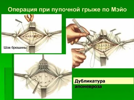 Пупочная грыжа методы операции