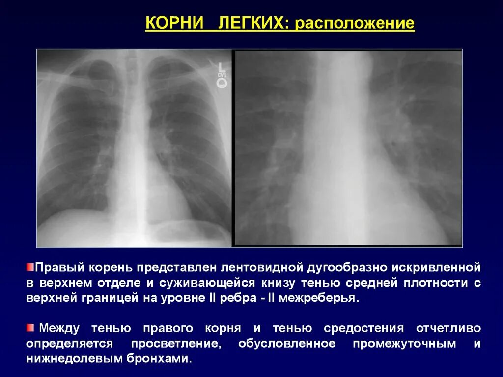 Левый корень легкого рентген. Корн легких структурны. Корень легкого на рентгенограмме. Расширение правого корня легкого. Корень легкого уплотнен что значит