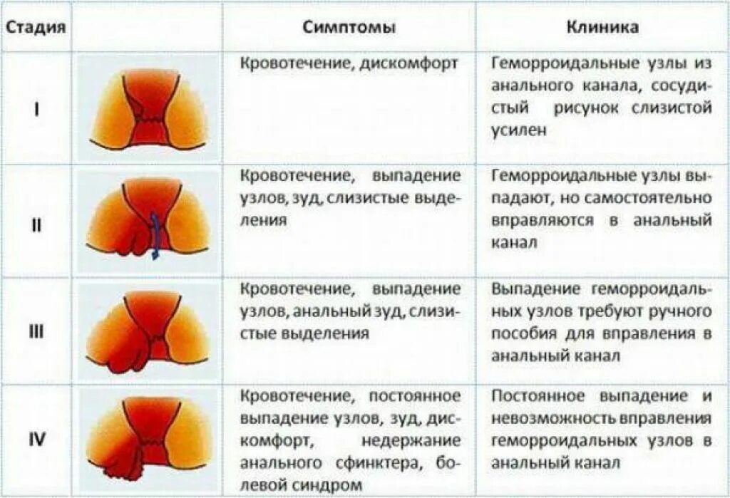 Стадии развития наружного геморроя. Геморрой при беременности 3 триместр симптомы. Форум о трещинах заднего