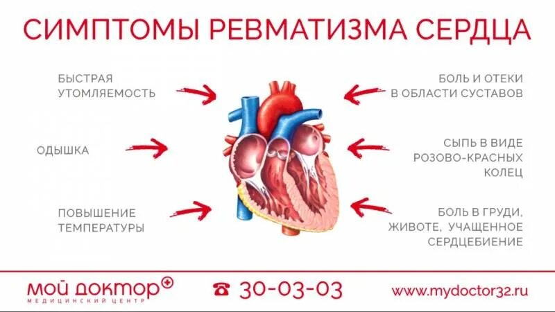 Основной признак ревмокардита. Признаки поражения сердца ревматической этиологии. Особенности поражение сердца при ревматизме у детей. Ревматизм симптомы сердечной формы заболевания. Ревматическая болезнь сердца (ревматизм).