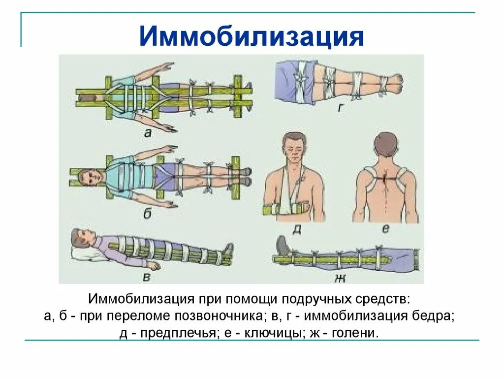 Алгоритм иммобилизации бедренной кости. Иммобилизация пострадавшего с переломом бедренной кости. Иммобилизация при переломе бедра. Иммобилизаия при перелом бедра.