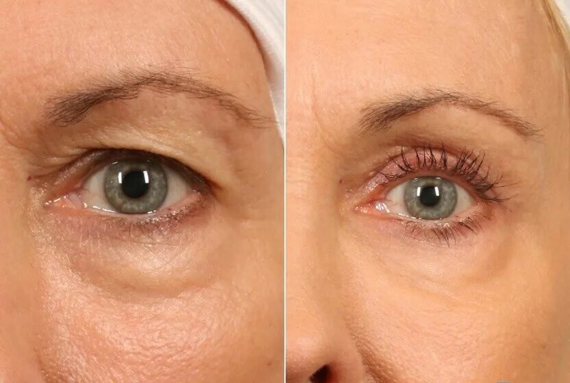 Нижнее веко подтяжка. Dermaheal eyebag solution от мешков под глазами. Мезо под глаза дермахил. Блефаропластика (пластика нижних век). Блефаропластика нависших век.