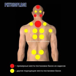 Схема Точек Для Хиджамы
