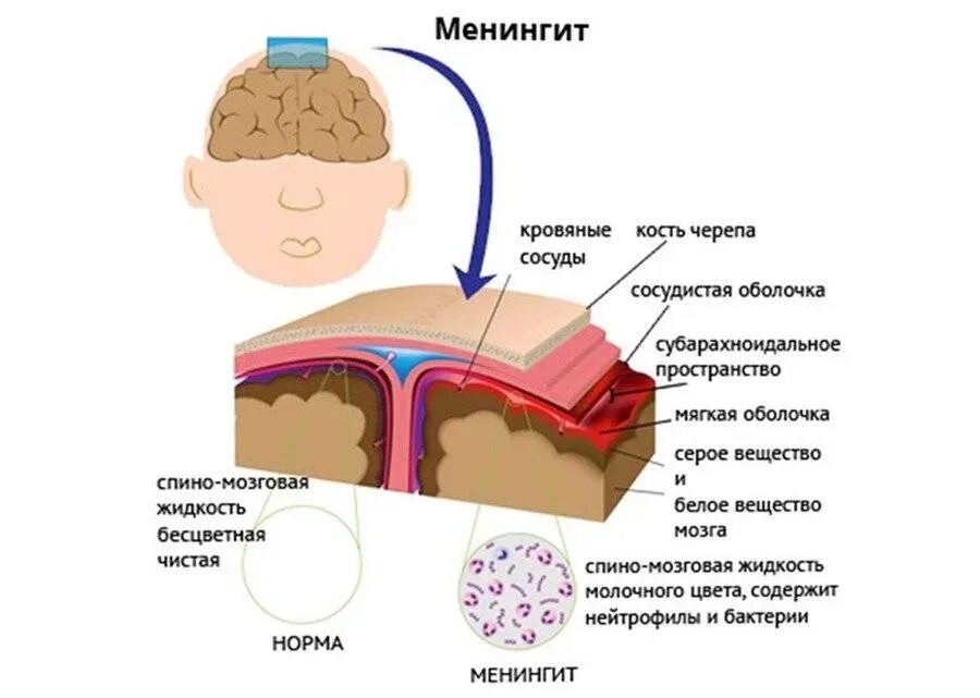 Симптомы менингита у человека. Менингит воспаление оболочек головного мозга. Воспаление мозговых оболочек симптомы у ребенка. Симптомы поражения мозговых оболочек при менингите. Менингит-инфекционное заболевание симптомы.