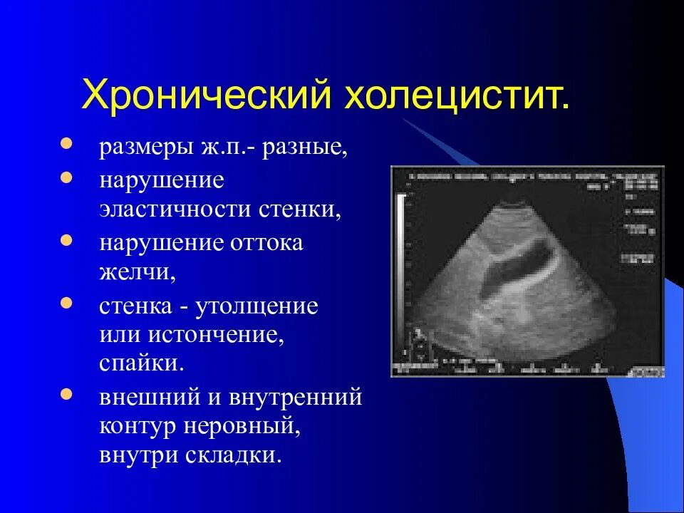 Диффузный холецистит. Острый калькулезный холецистит узи. узи желчного пузыря хронический холецистит. узи признаки хронического холецистита.
