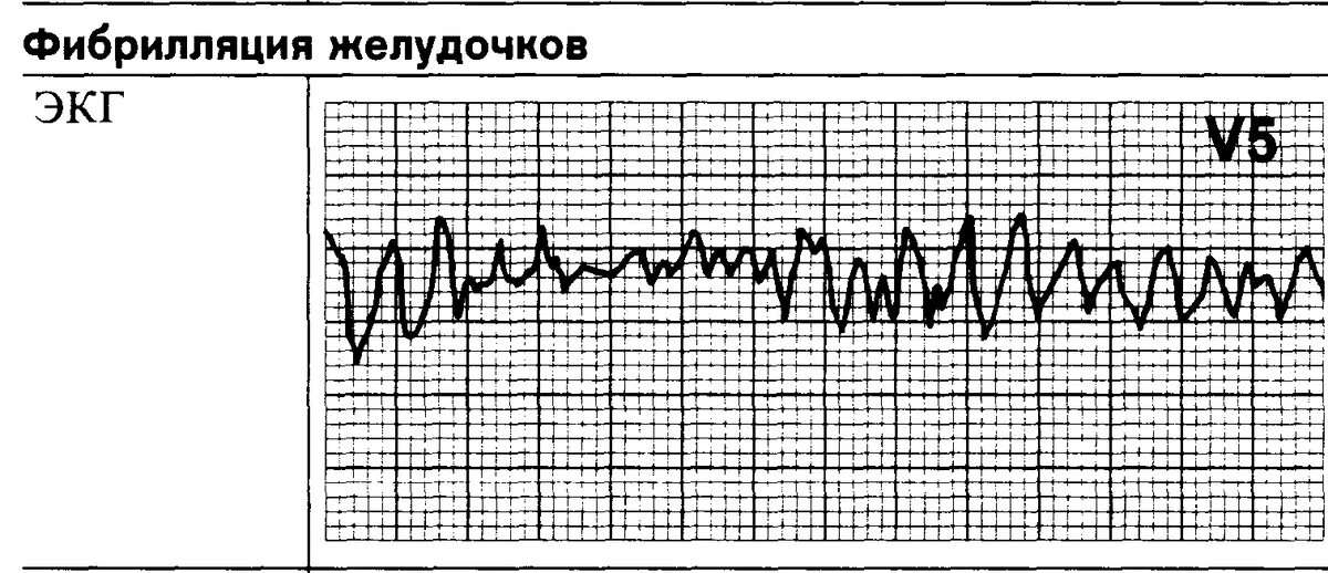 Фж юлчкжсл цхшлтптпшг шхчхс юлщвчл илшлтвь юпнж. Мелковолновая фибрилляция желудочков ЭКГ. Трепетание желудочков мелковолновае ЭКГ. ЭКГ при фибрилляции желудочков. Крупноволновая фибрилляция желудочков на ЭКГ.