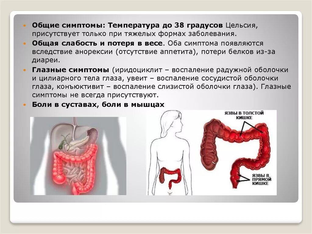 Колит кишечника симптомы. Язвенный колит симптомы.