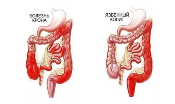 Язвенный колит и болезнь крона. ПЭТ колит.