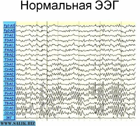 Ээг невролог. Электроэнцефалография головного мозга (ЭЭГ). Энцефалограмма головного мозга ребенку. Нормальная диаграмма ЭЭГ. Электроэнцефалография или ЭЭГ.