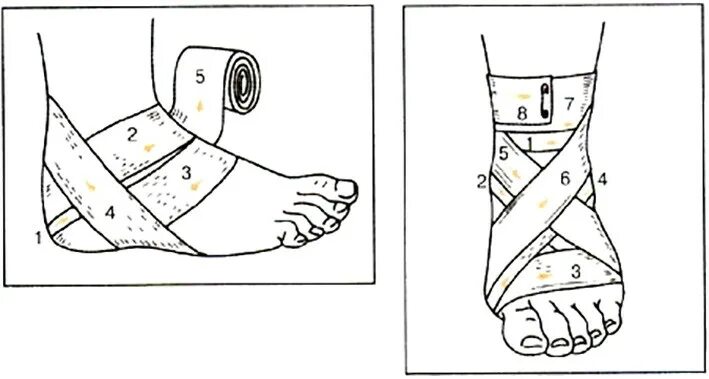 Бинтование голеностопа эластичным бинтом. Десмургия повязка восьмиобразная на голеностопный сустав. Растяжение связок голеностопного сустава бинтование. Перевязка голеностопа эластичным бинтом при растяжении. Наложение эластичного бинта на конечность