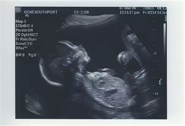 Узи плода 17 недель беременности. 17 недель беременности какой размер. Плод на 17 неделе беременности. 17 недель беременности какой размер. 17 недель беременности какой размер.