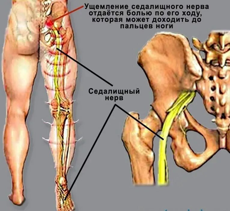 Защемление нерва в спине поясница. Анатомия седалищного нерва у человека. Седалищный нерв схема. Где находится седалищный нерв у человека фото. Седалищный и бедренный нерв.