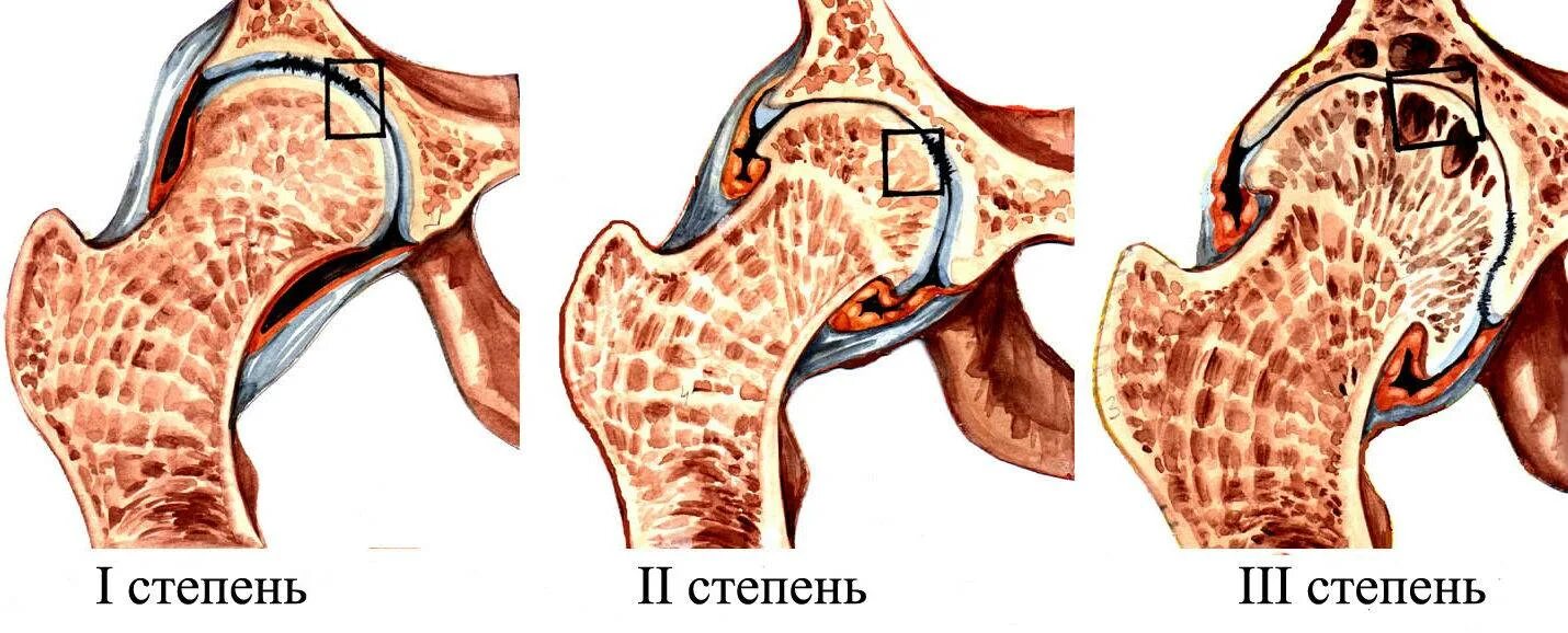 Заболевание коксартроз тазобедренного сустава. Коксартроз тазобедренного сустава 2. 2 Степень коксартроза тазобедренного. Посттуберкулезный коксартроз.