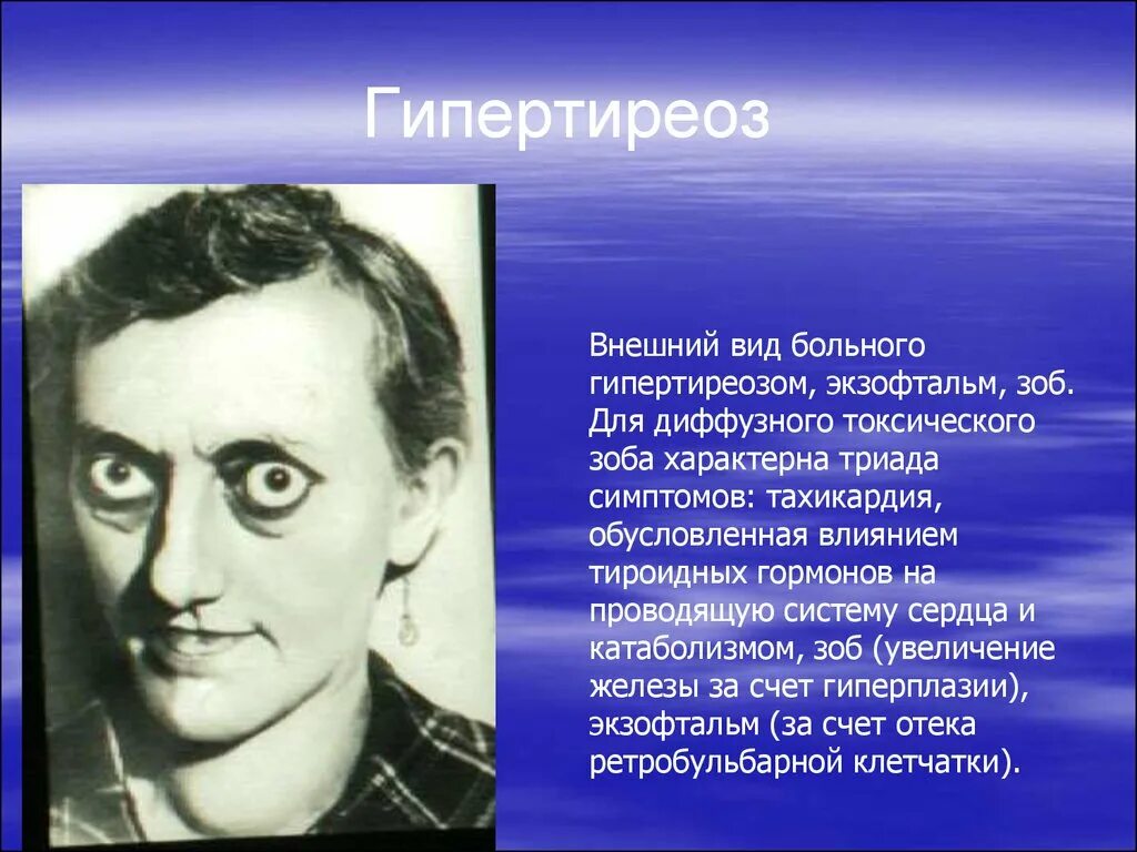 Гипертиреоз внешний вид. Гипертиреоз и тиреотоксикоз.