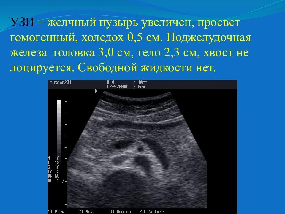 Диаметр желчных протоков в норме УЗИ. Общий желчный проток на УЗИ. Диаметр общего желчного протока в норме на УЗИ. УЗИ желчного пузыря норма желчных протоков. Норма желчного пузыря у мужчин