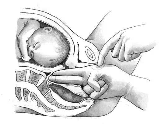 регулярной родовой деятельности. шейка матки раскрытие. раскрытие шейной матки. осмотр раскрытия шейки. этапы раскрытия шейки матки.