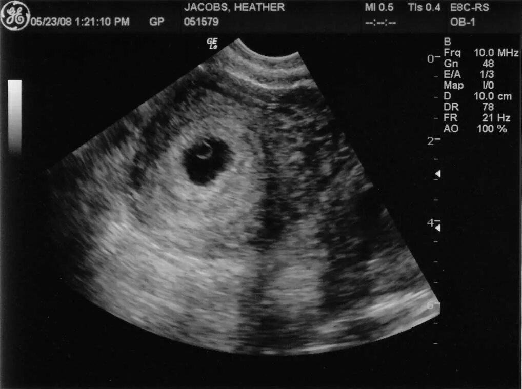 Беременность 5 недель фото. УЗИ плода 4 недели беременности. 4.4 Недели беременности УЗИ. Эмбрион на 4 неделе беременности УЗИ. Снимок УЗИ на 4 неделе беременности.