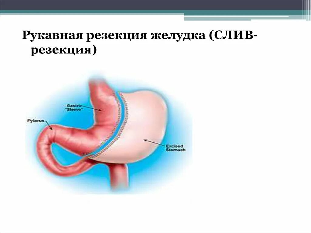 Умер от резекции желудка. Лапароскопическая продольная «рукавная» резекция желудка. Бариатрическая операция рукавная резекция желудка. Продольная резекция желудка схема.