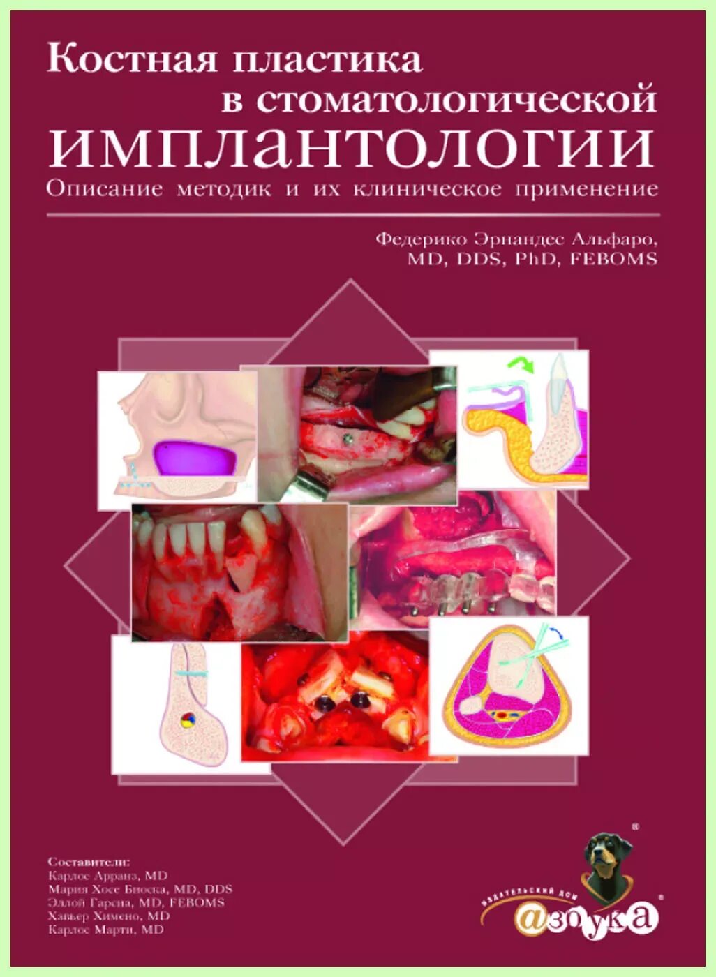 Костная пластика по. Аугментация костной ткани челюсти. Костная пластика скользящим трансплантатом. Костная пластика по. Костная пластика по.