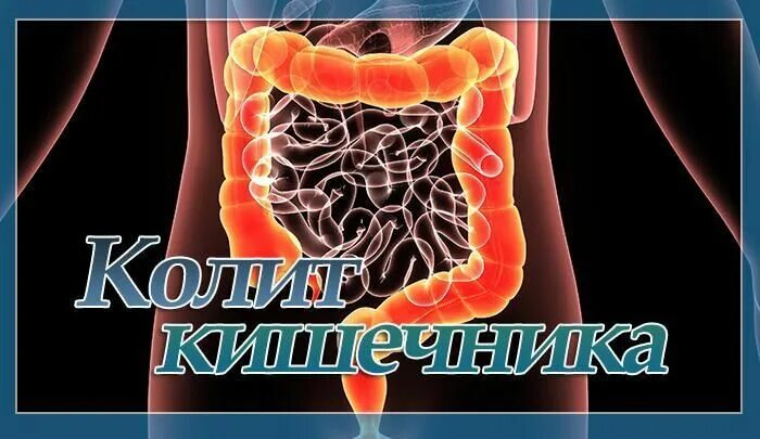 Кишечные инфекции колит. Энтерит колит энтероколит. Язвенный колит толстой кишки. Воспаление кишечника энтерит. Неспецифический язвенный колит слизистая.