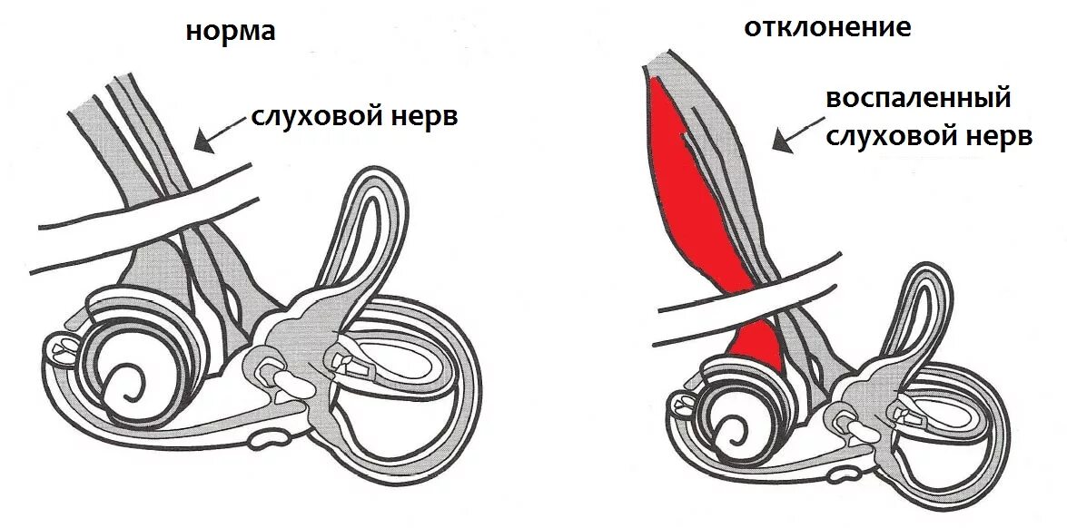 Поражение слухового нерва. Слуховой нерв симптомы поражения. Симптомы патологии слухового нерва. Кохлеарный неврит слухового нерва. Неврит слухового нерва (кохлеарный неврит).