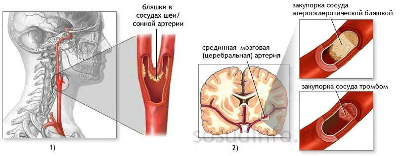 Атеросклероз сосудов сонных артерий. Атеросклероз бляшка сонной артерии. Окклюзия сосудов головного мозга операция. Атеросклероз бляшка сонной артерии операция. Бляшка на шее операция