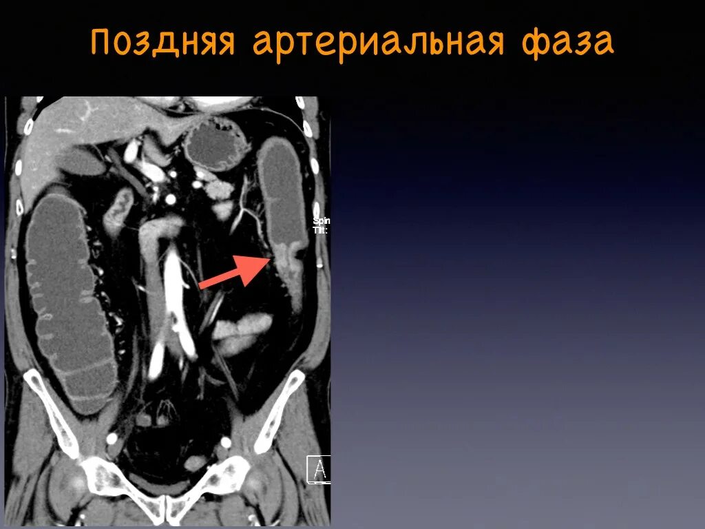 Кт брюшной полости (контрастирование. Кт брюшной полости и забрюшинного пространства с контрастом. Инфильтрат брюшной полости на кт. Кт с контрастом забрюшинного пространства.