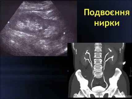 Удвоение почки на узи