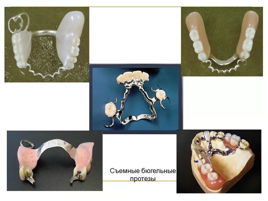Съемный пластиночный протез показания. Бюгельный протез кламмерный (remanium-700). Бюгельный и пластиночный протез. Бюгельный мостовидный протез. Бюгельный съемный протез показания.