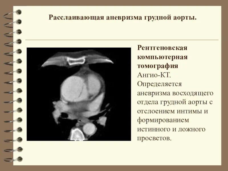 Расслаивающаяся аневризма аорты. Расслаивающая аневризма аорты кт. кт признаки расслаивающей аневризмы аорты. кт при расслаивающей аневризме аорты. расслаивающая аневризма грудной.
