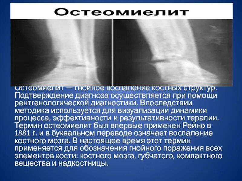 Гематогенный остеомиелит рентген. Хронический остеомиелит рентген. Остеомиелит бедренной кости рентген. Рентгенологические симптомы остеомиелита. Хронический остеомиелит рентген протокол.