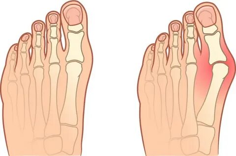 Hallux valgus что это такое
