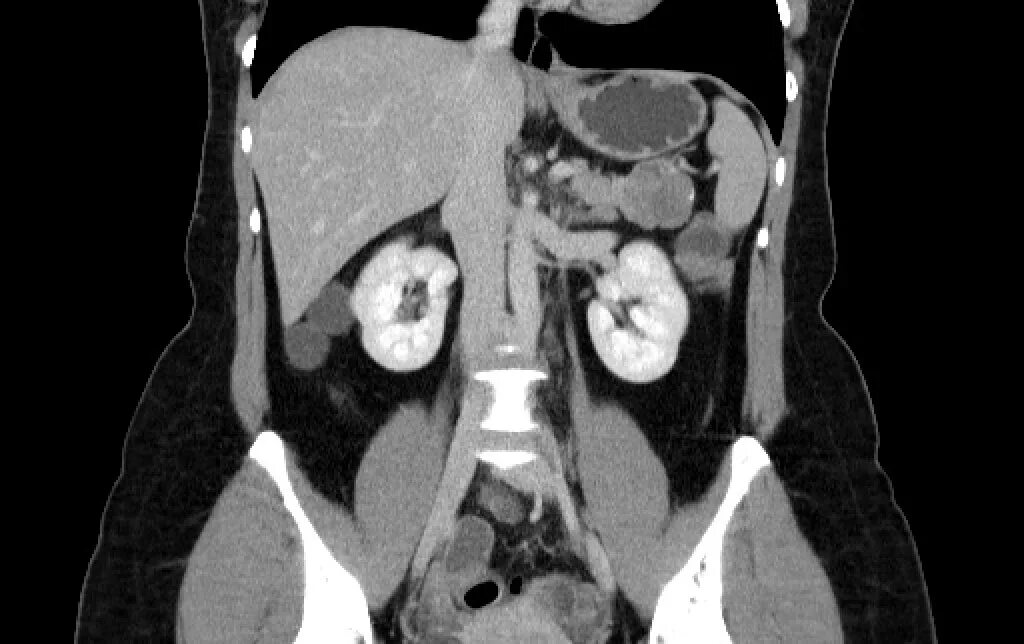 Солидная псевдопапиллярная. Карцинома поджелудочной железы гистология. Инсулинома гистология. Солидная псевдопапиллярная опухоль поджелудочной железы мрт. Опухоль поджелудочной железы на кт.