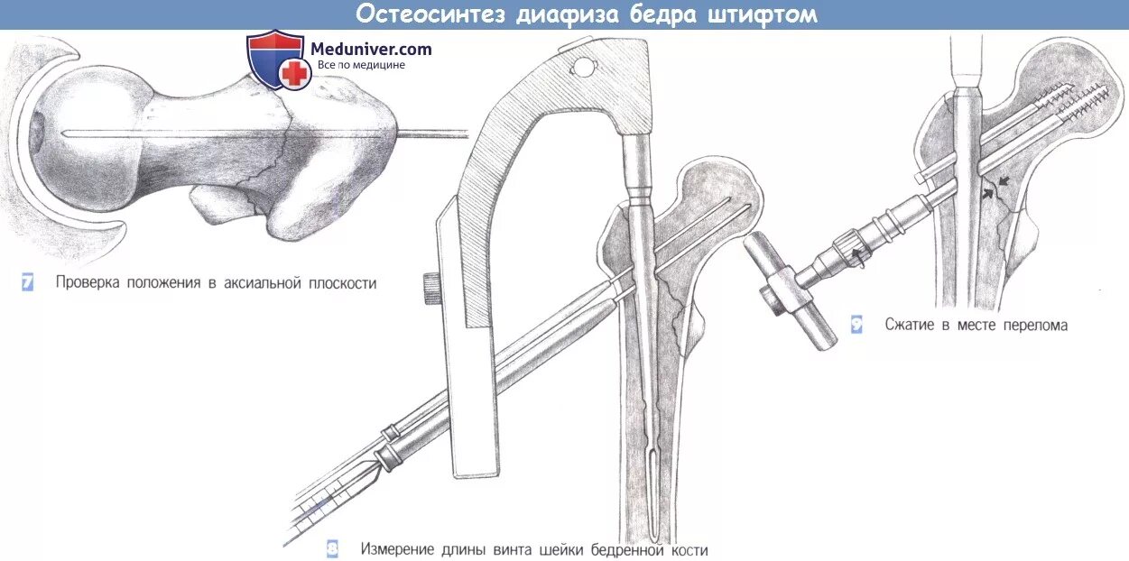 Шейка бедра перелом остеосинтез. Остеосинтез шейки бедра штифтом. Гамма штифт для бедренной кости методика операции. Гамма штифт при переломе шейки бедра. Операция остеосинтез шейки бедра